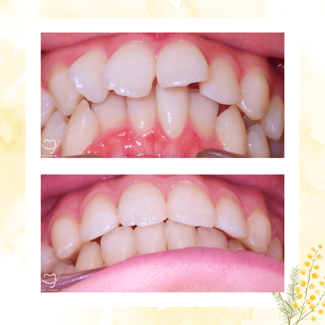 デコボコの症例