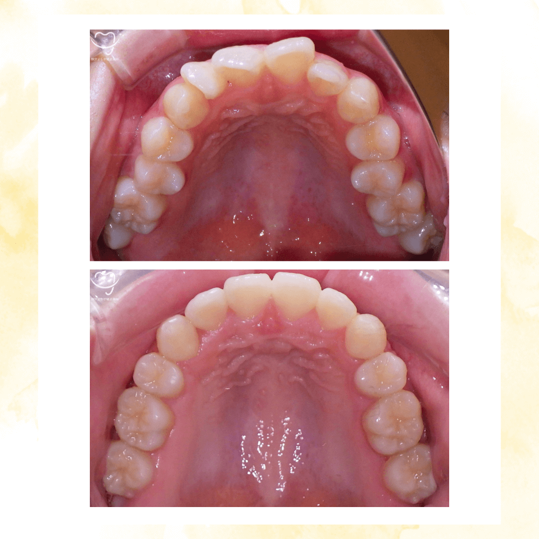 デコボコの症例