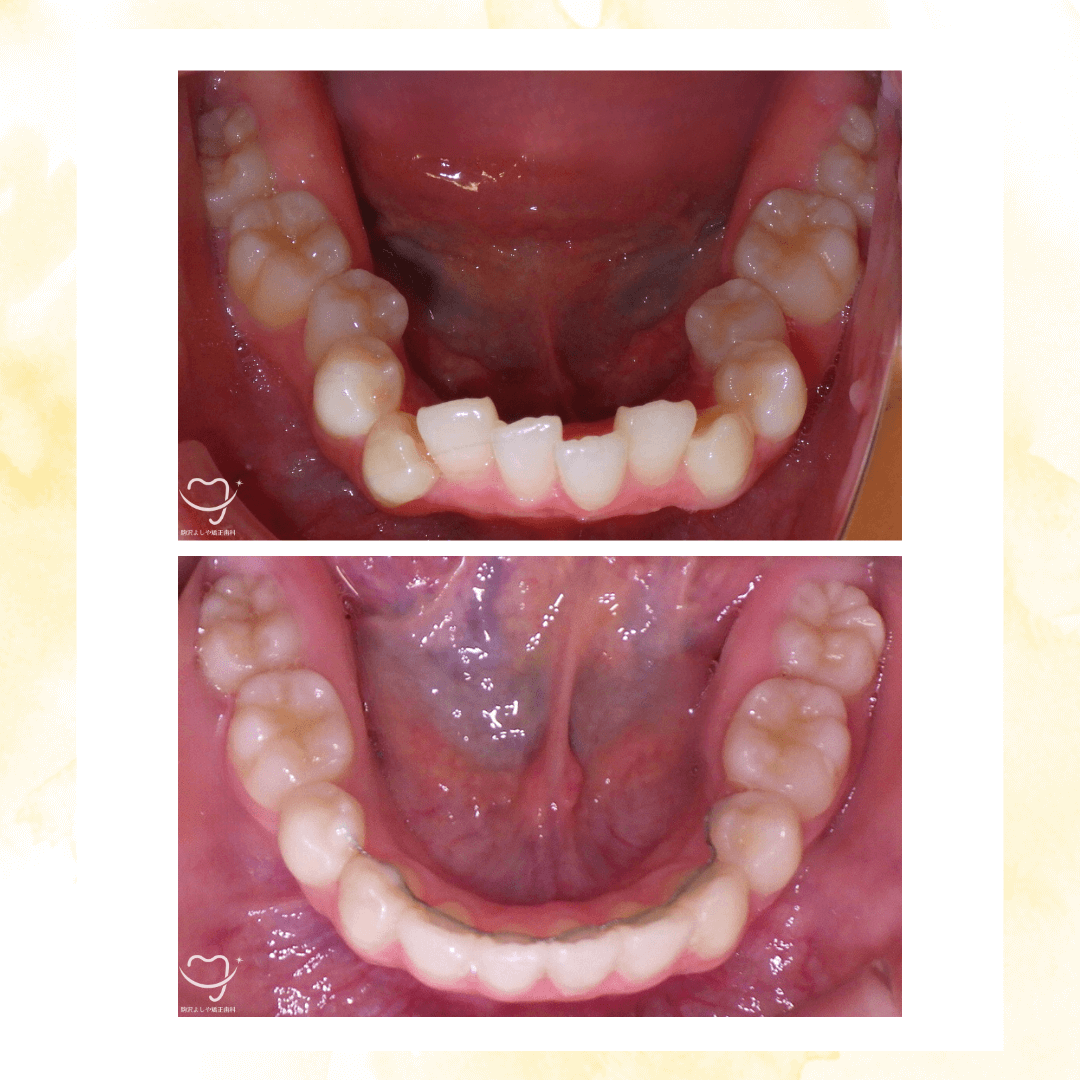 デコボコの症例