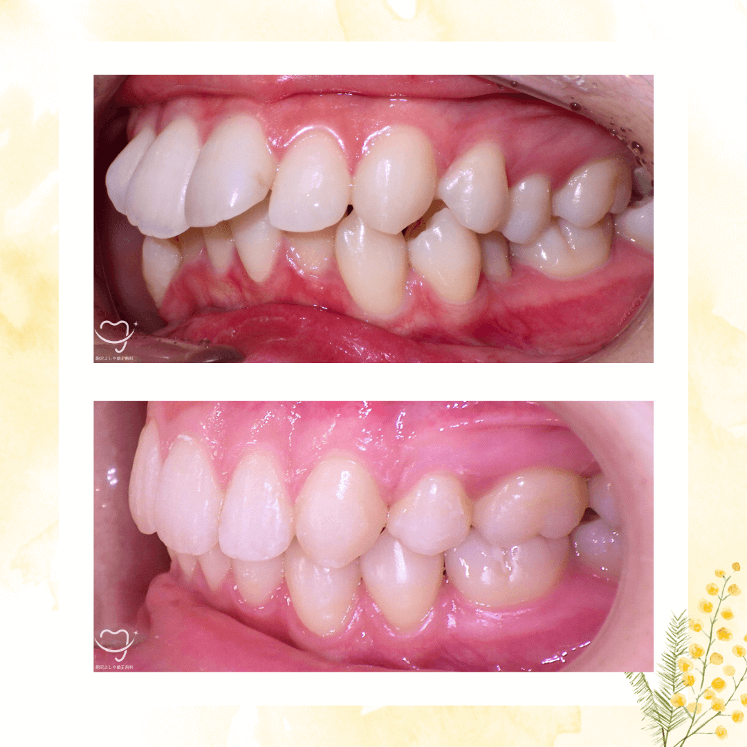 デコボコの症例