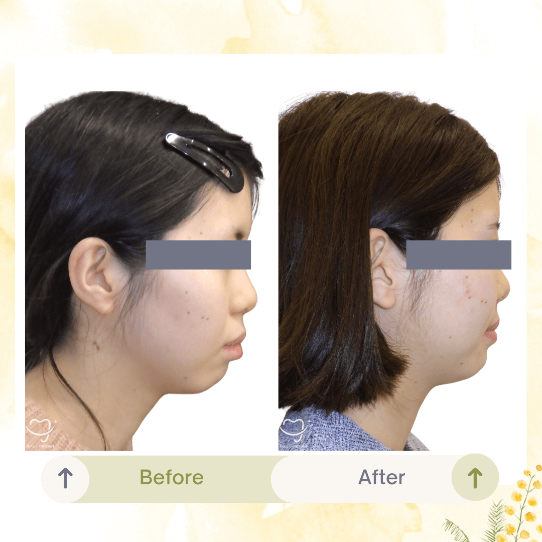 デコボコの症例