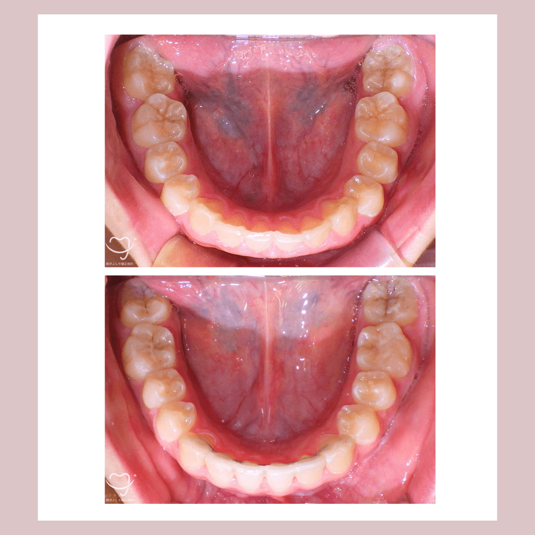 デコボコの症例