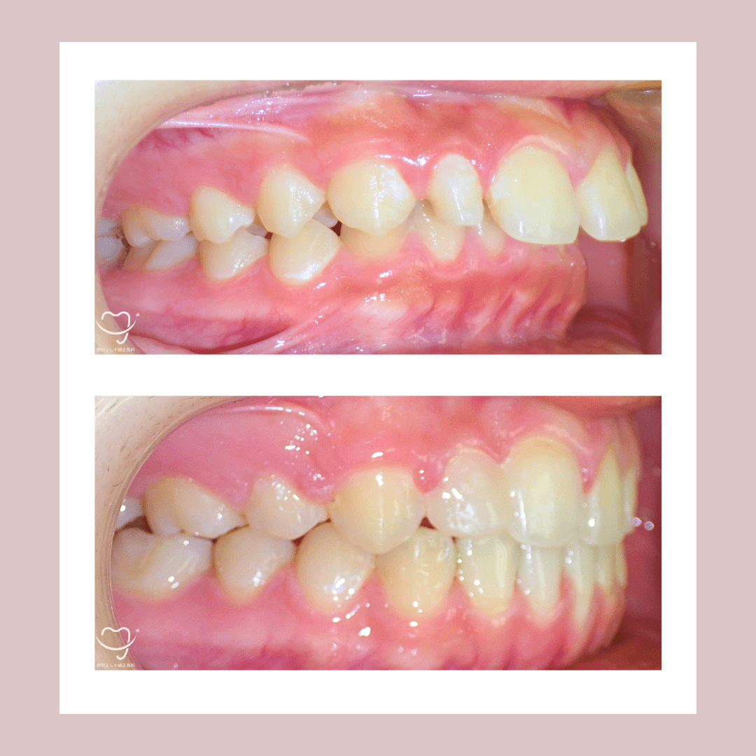 デコボコの症例