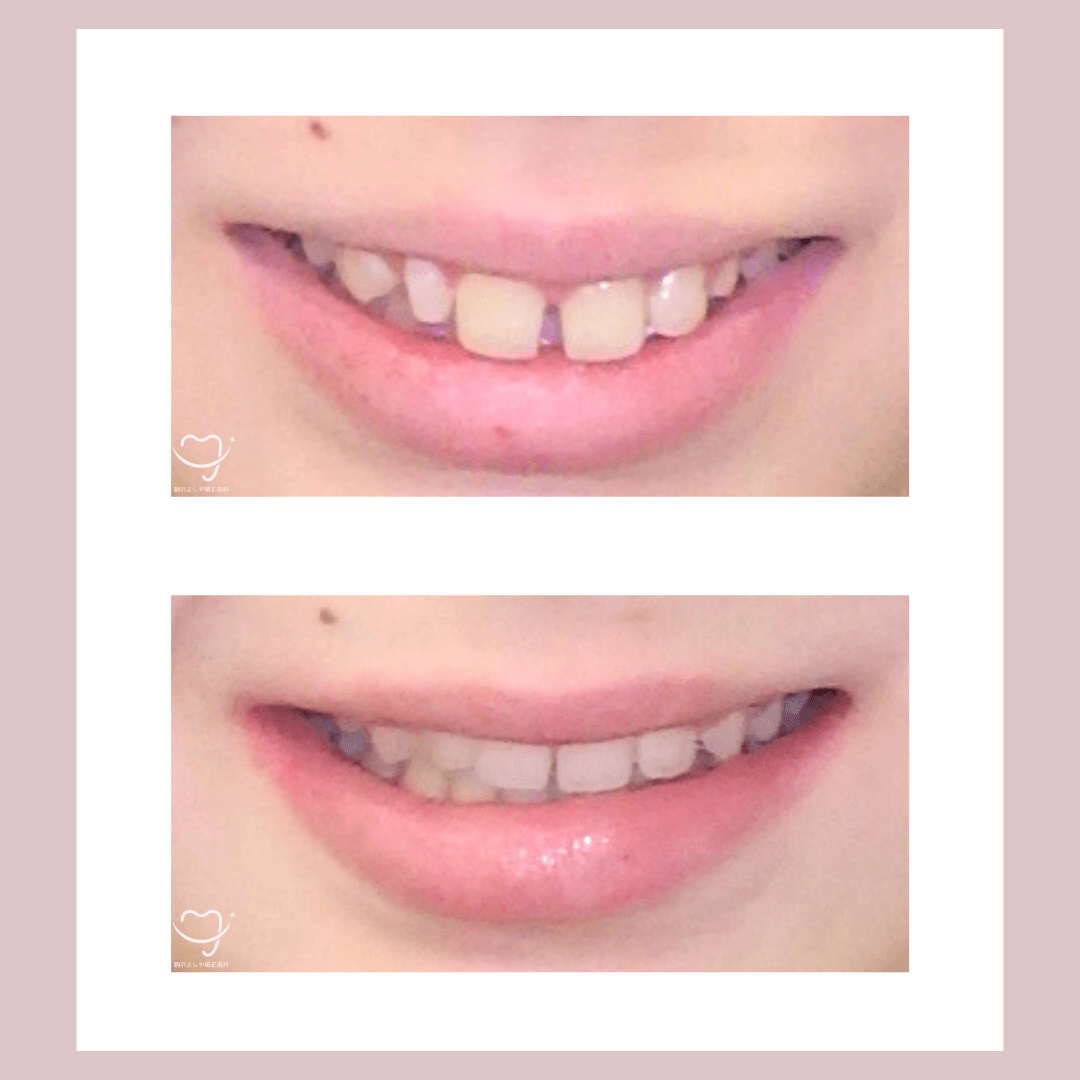 デコボコの症例