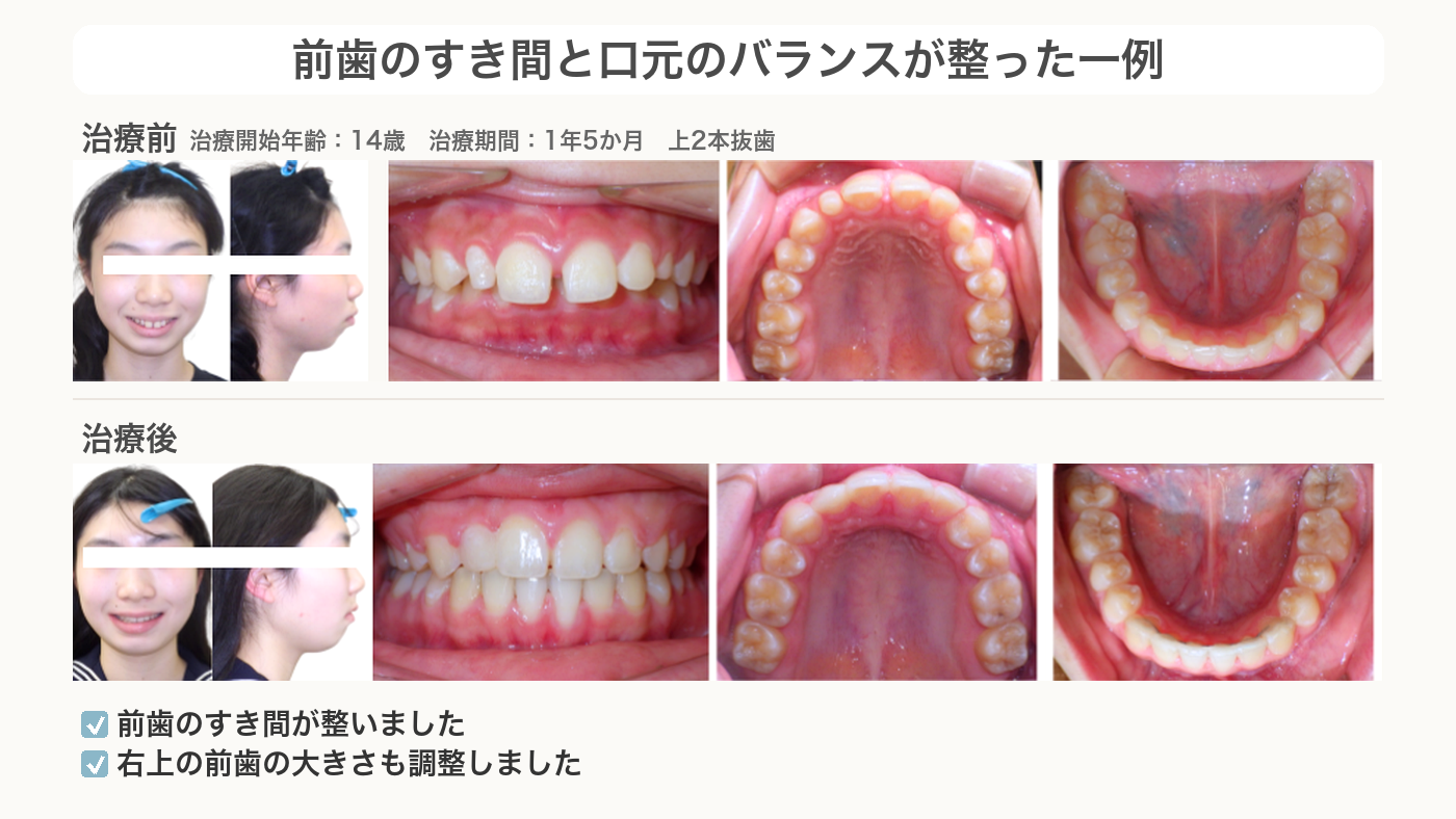 前歯のすき間と口元のバランスが整ったすきっ歯の症例