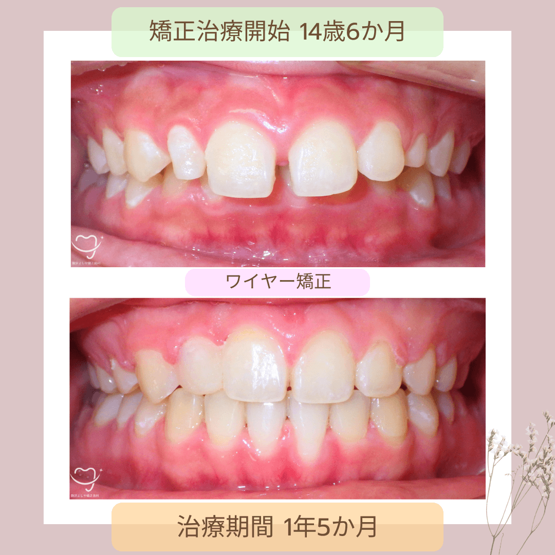 深い噛み合わせの症例