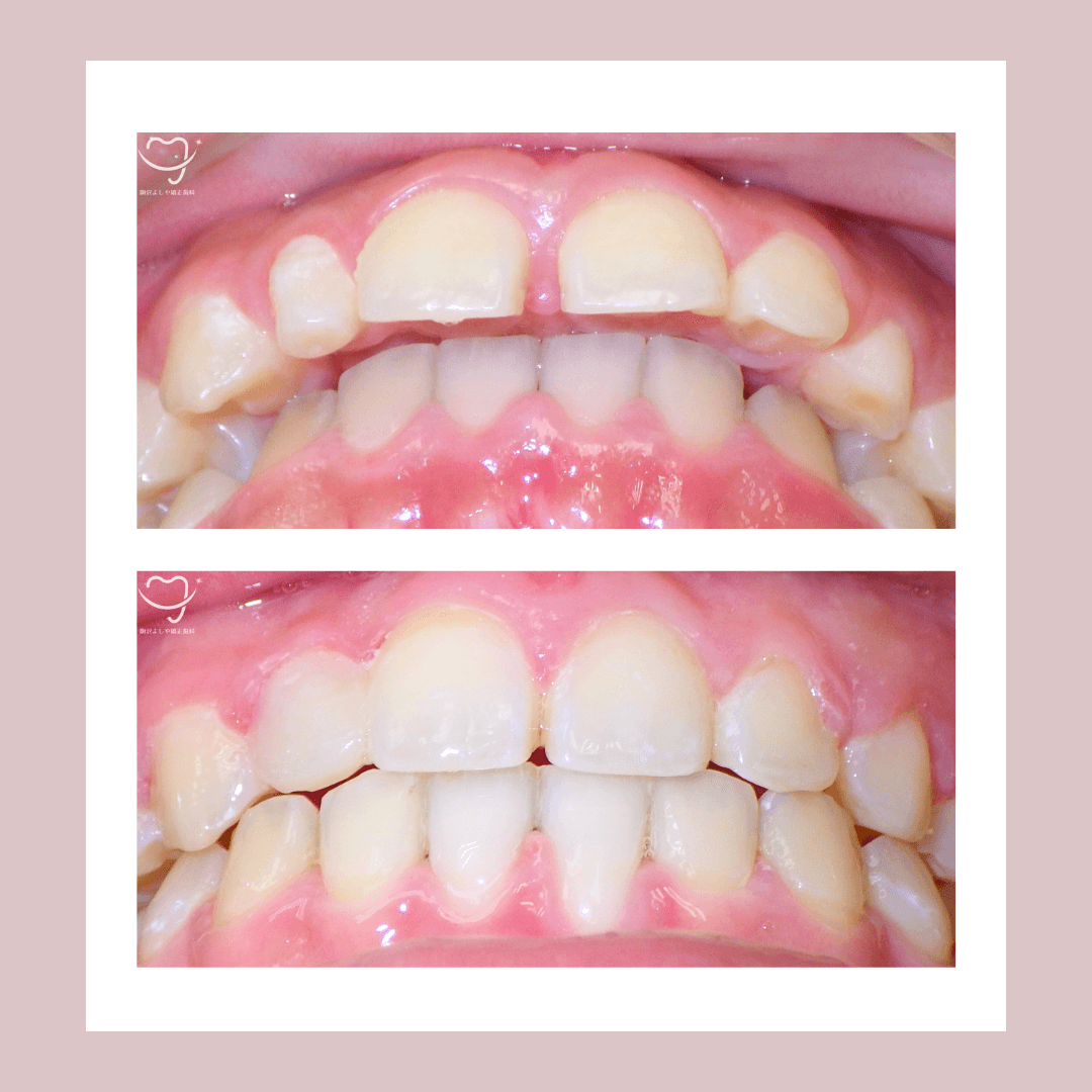 深い噛み合わせの症例