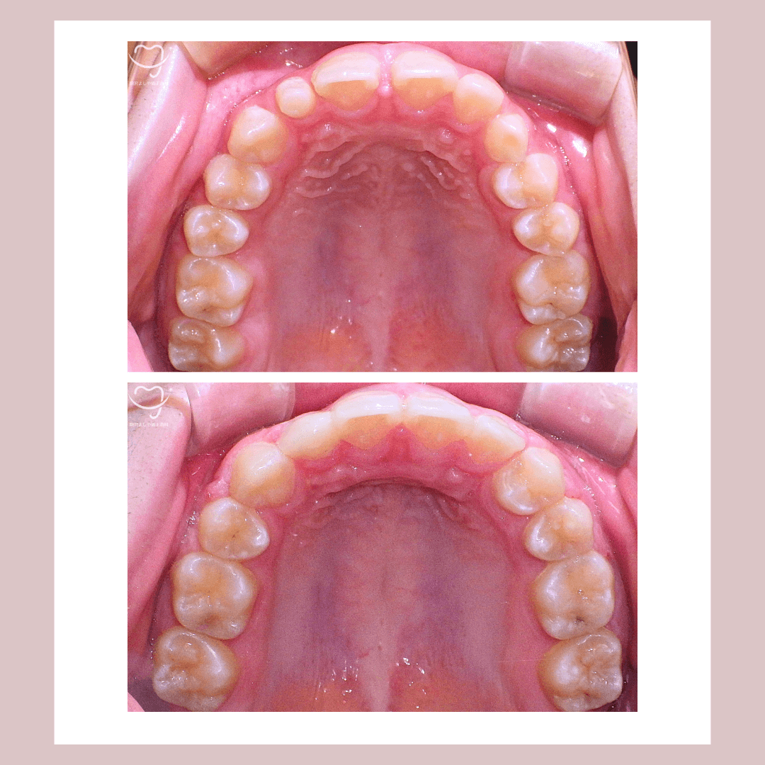 深い噛み合わせの症例