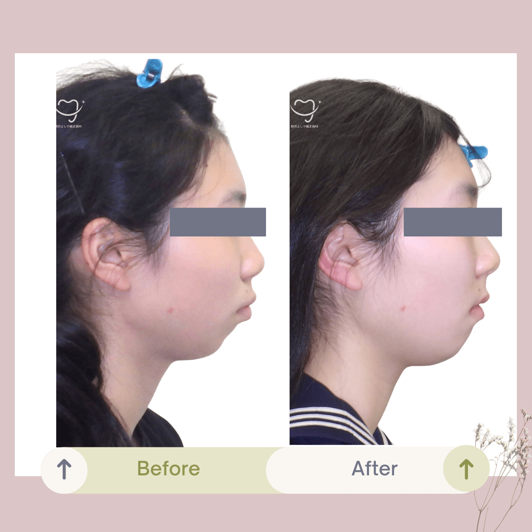 深い噛み合わせの症例