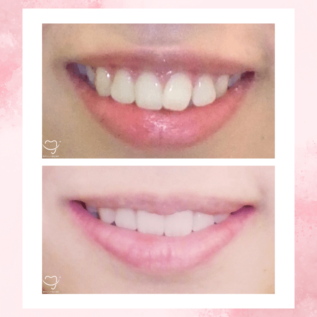 上下顎前突の症例