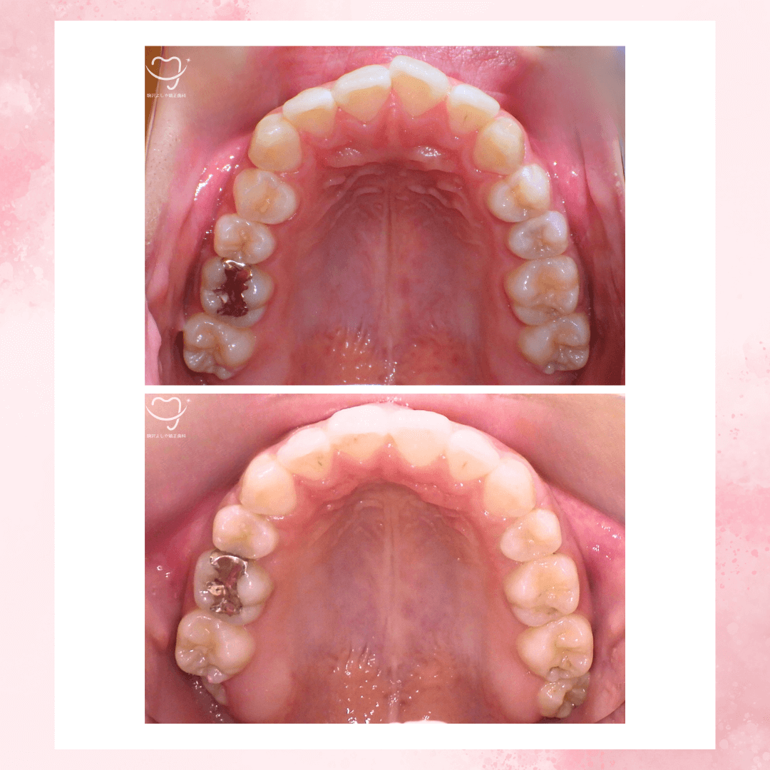 上下顎前突の症例