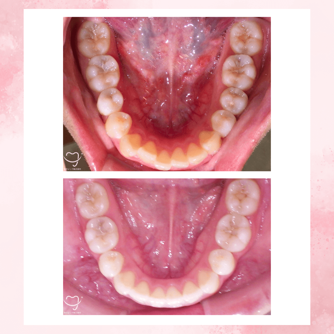 上下顎前突の症例