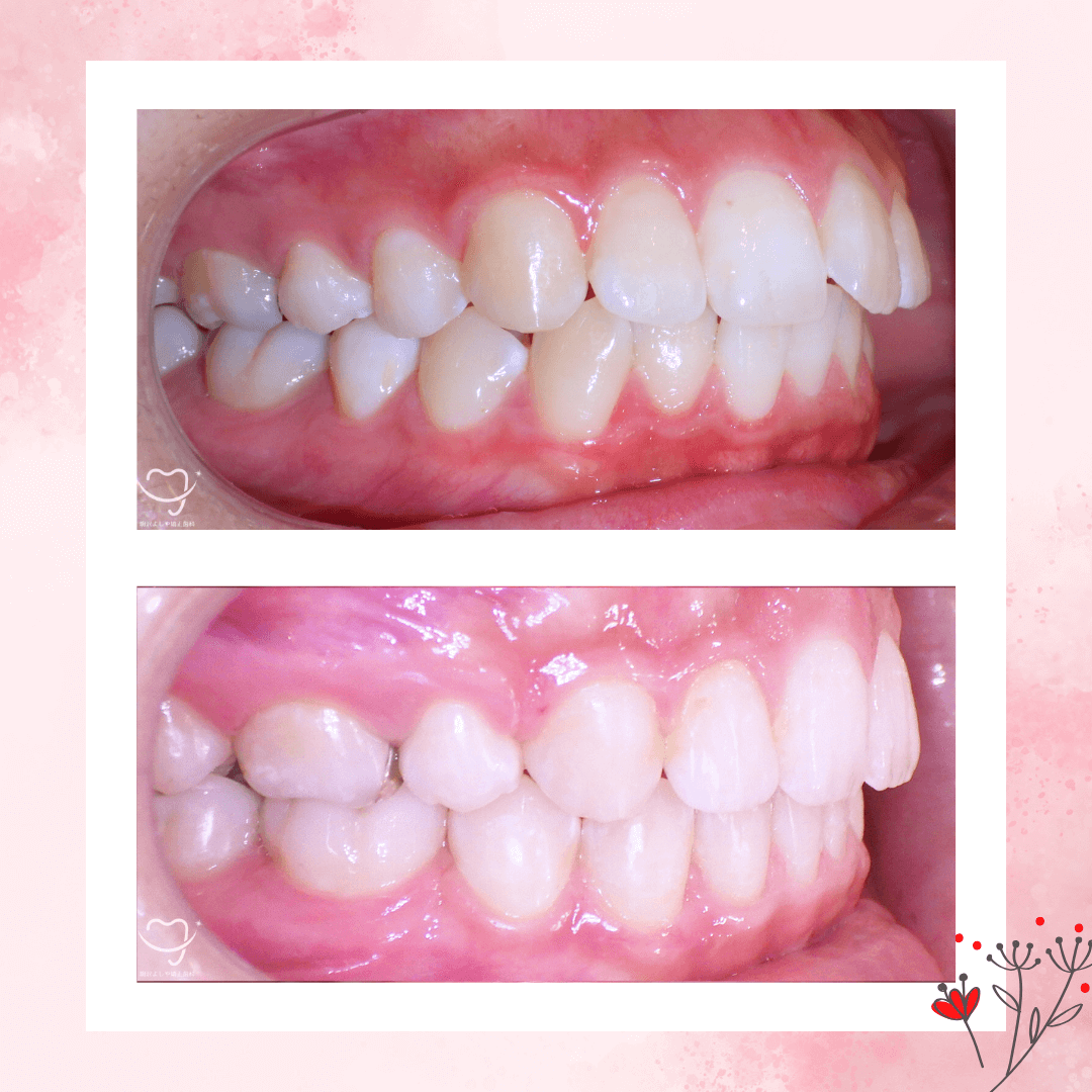 上下顎前突の症例