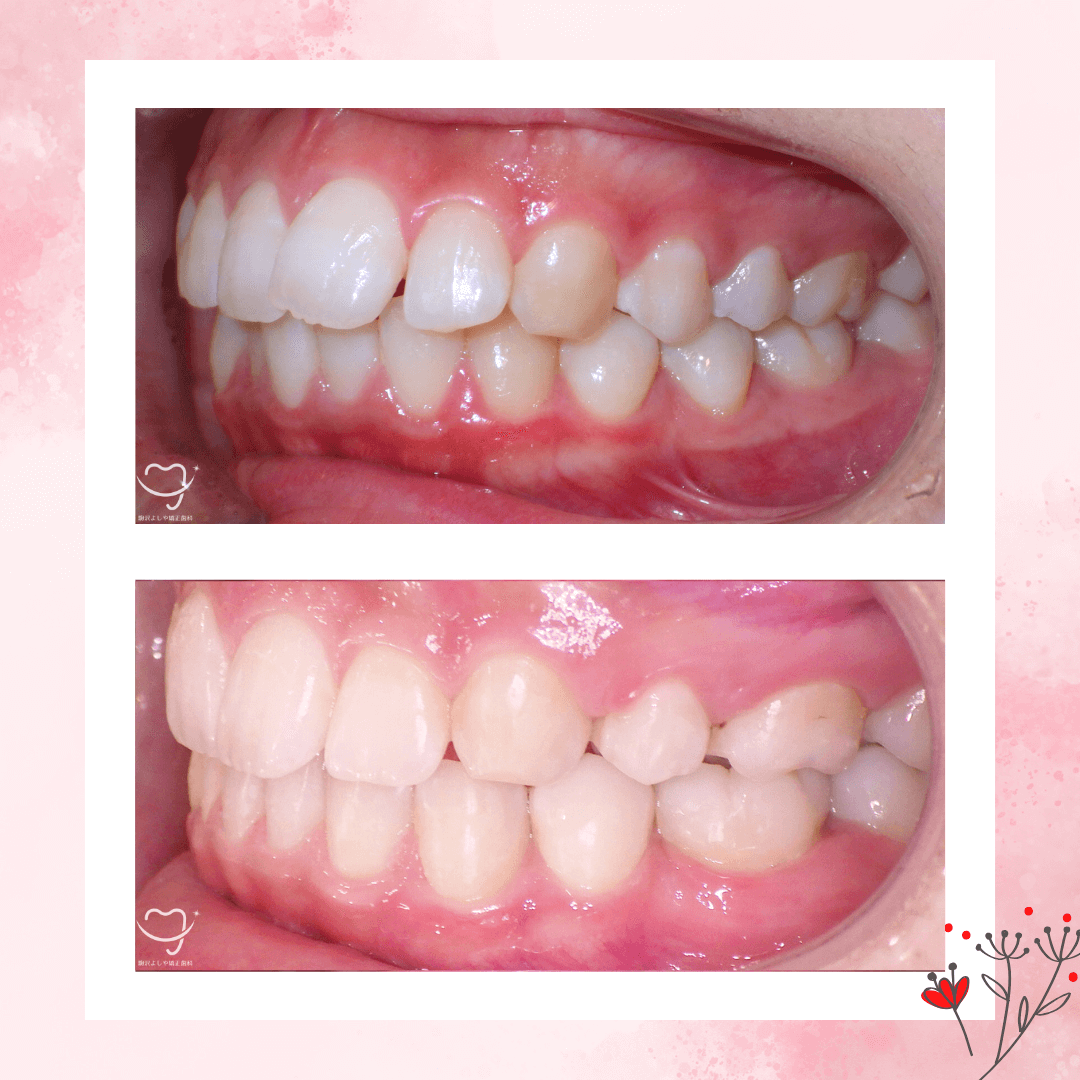 上下顎前突の症例