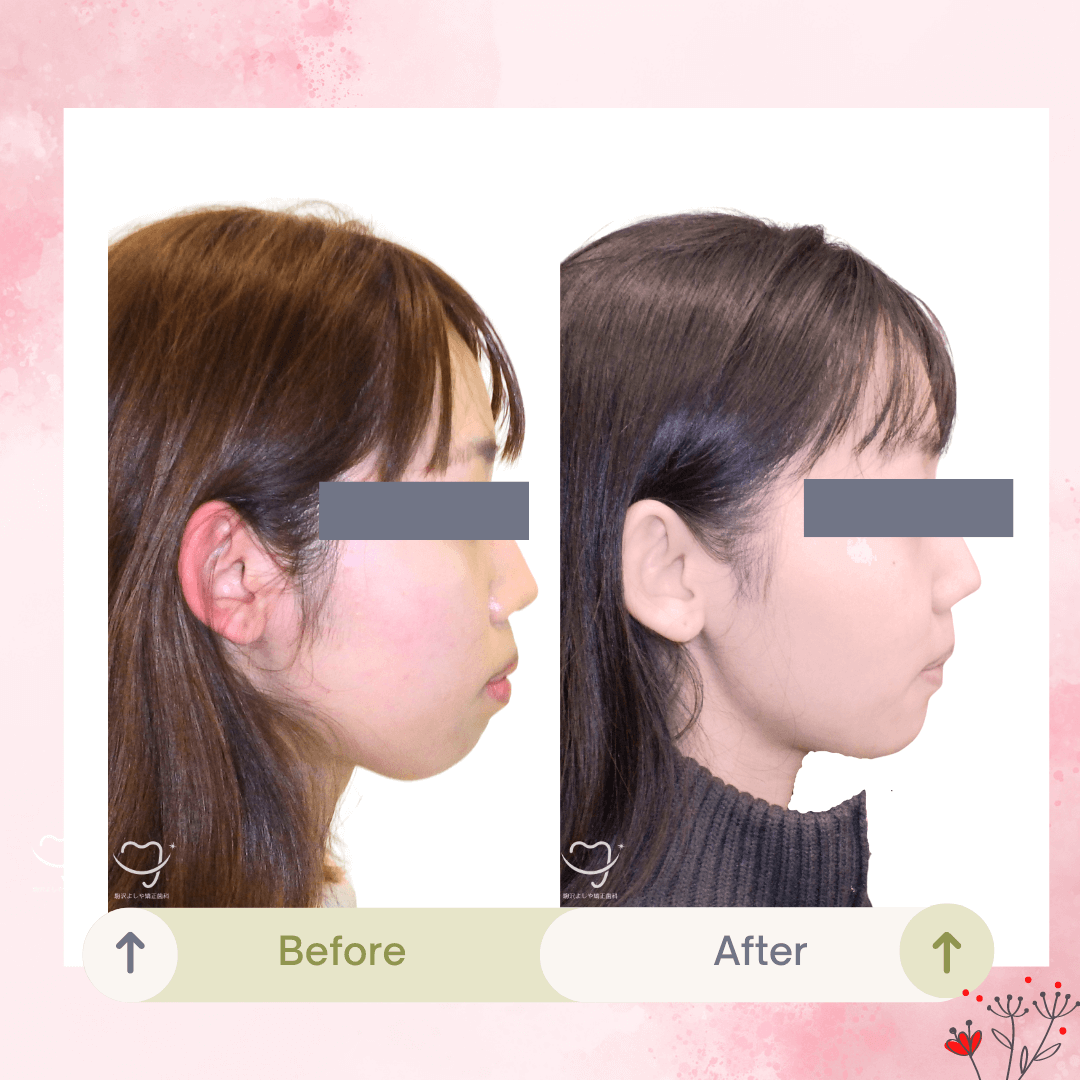 上下顎前突の症例