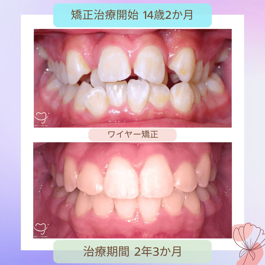 交叉咬合の症例