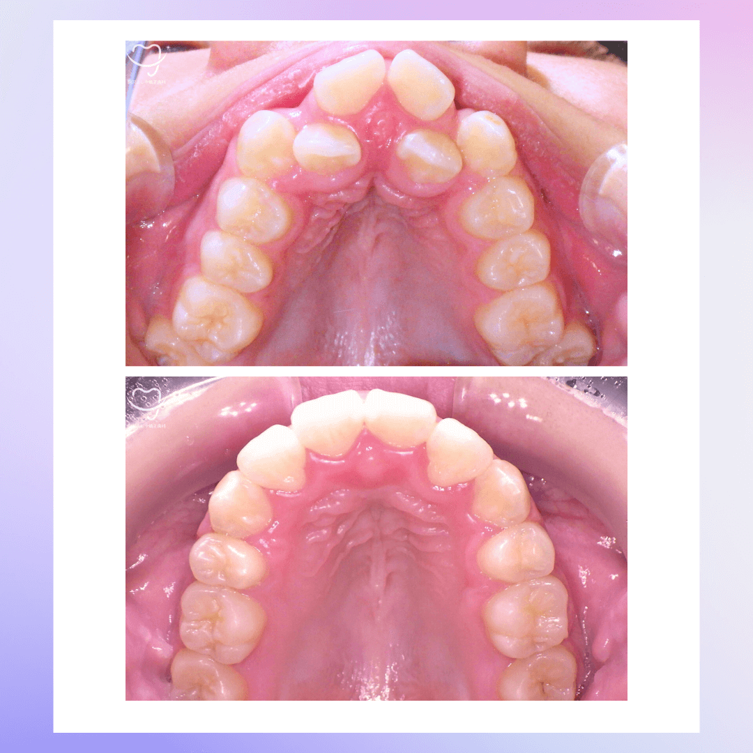 交叉咬合の症例