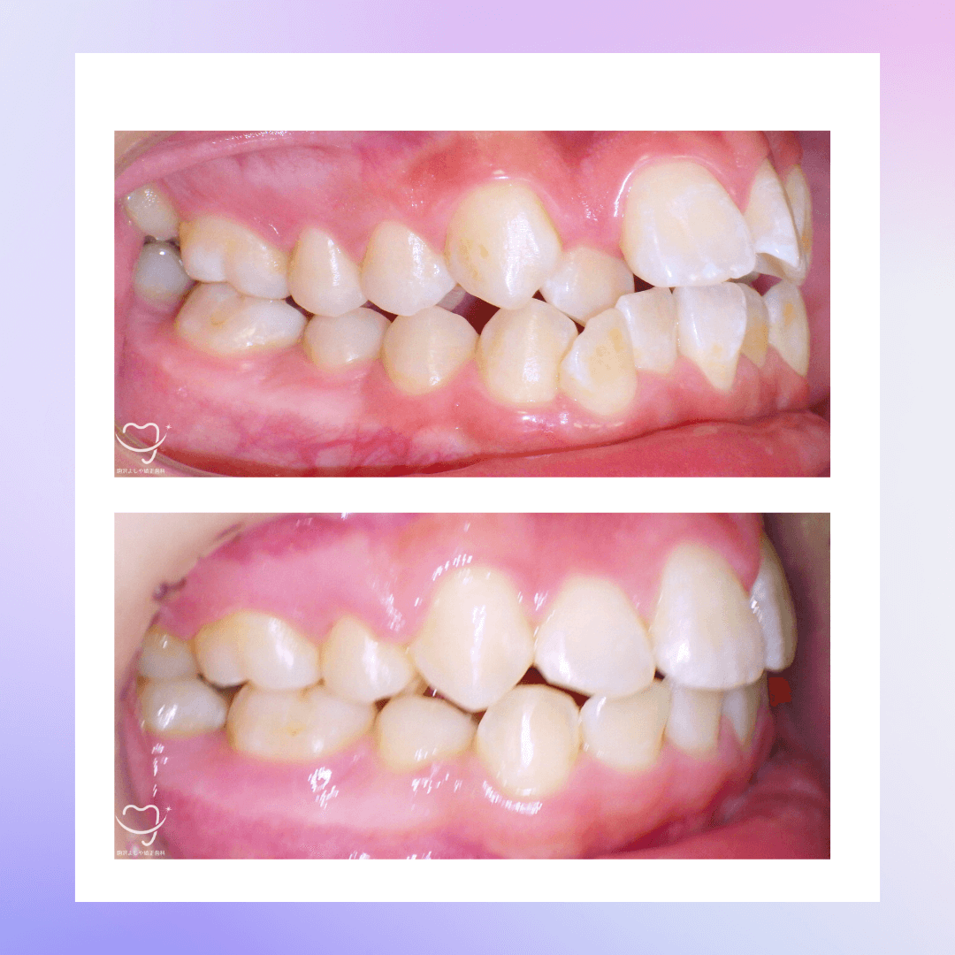 交叉咬合の症例