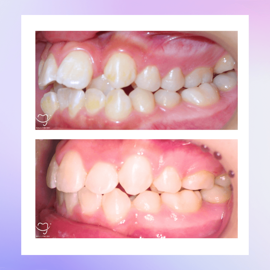 交叉咬合の症例