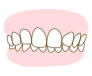 深い咬み合わせ