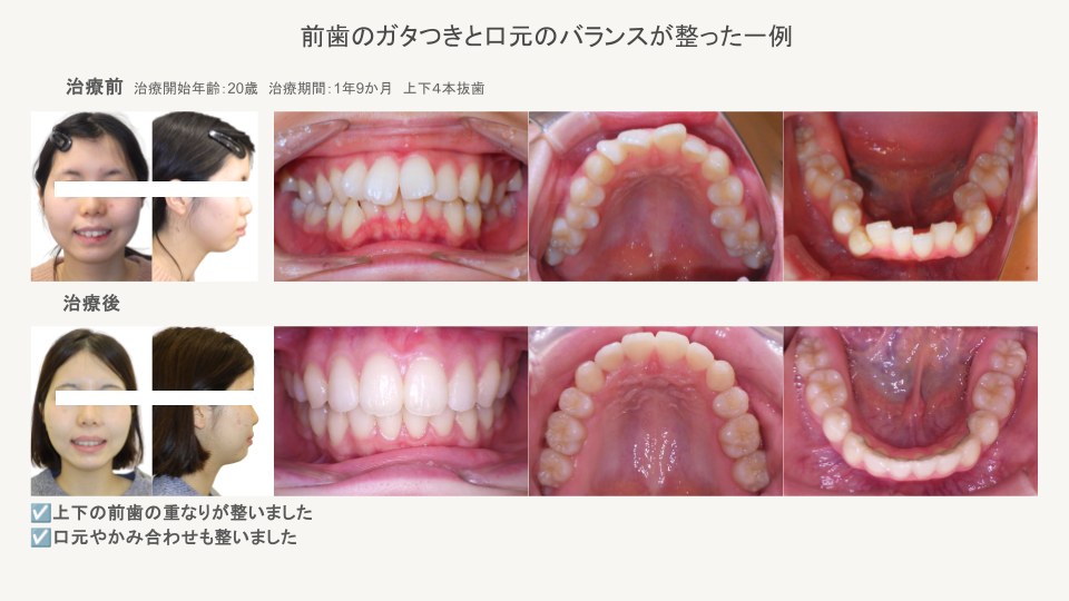 前歯のガタつきと口元のバランスが整った大人の歯並び治療症例