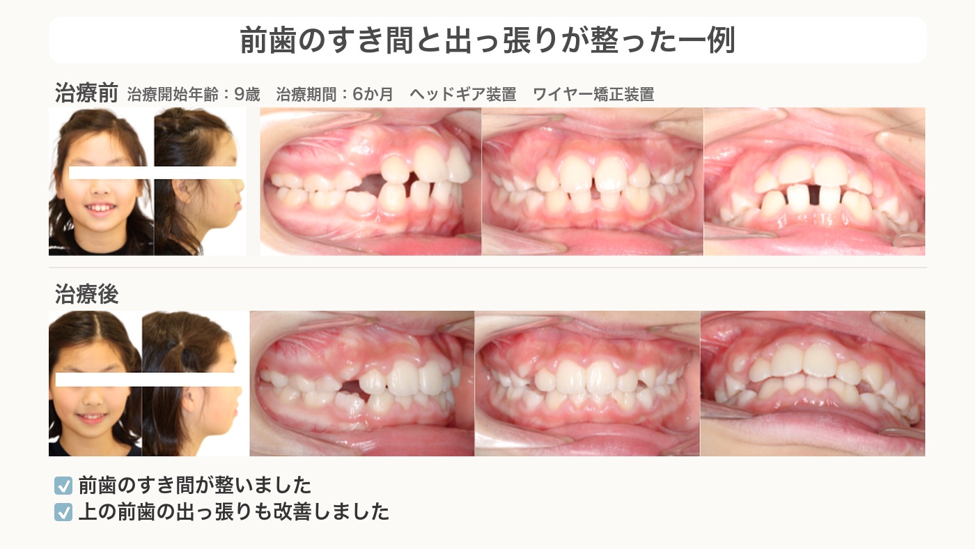 前歯のすき間と出っ張りが整った出っ歯の症例