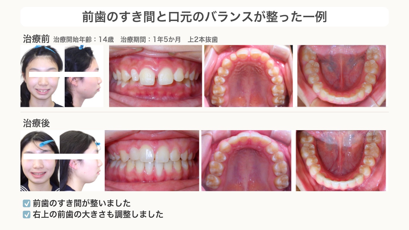 前歯のすき間と深い咬み合わせ、口元のバランスが整った症例