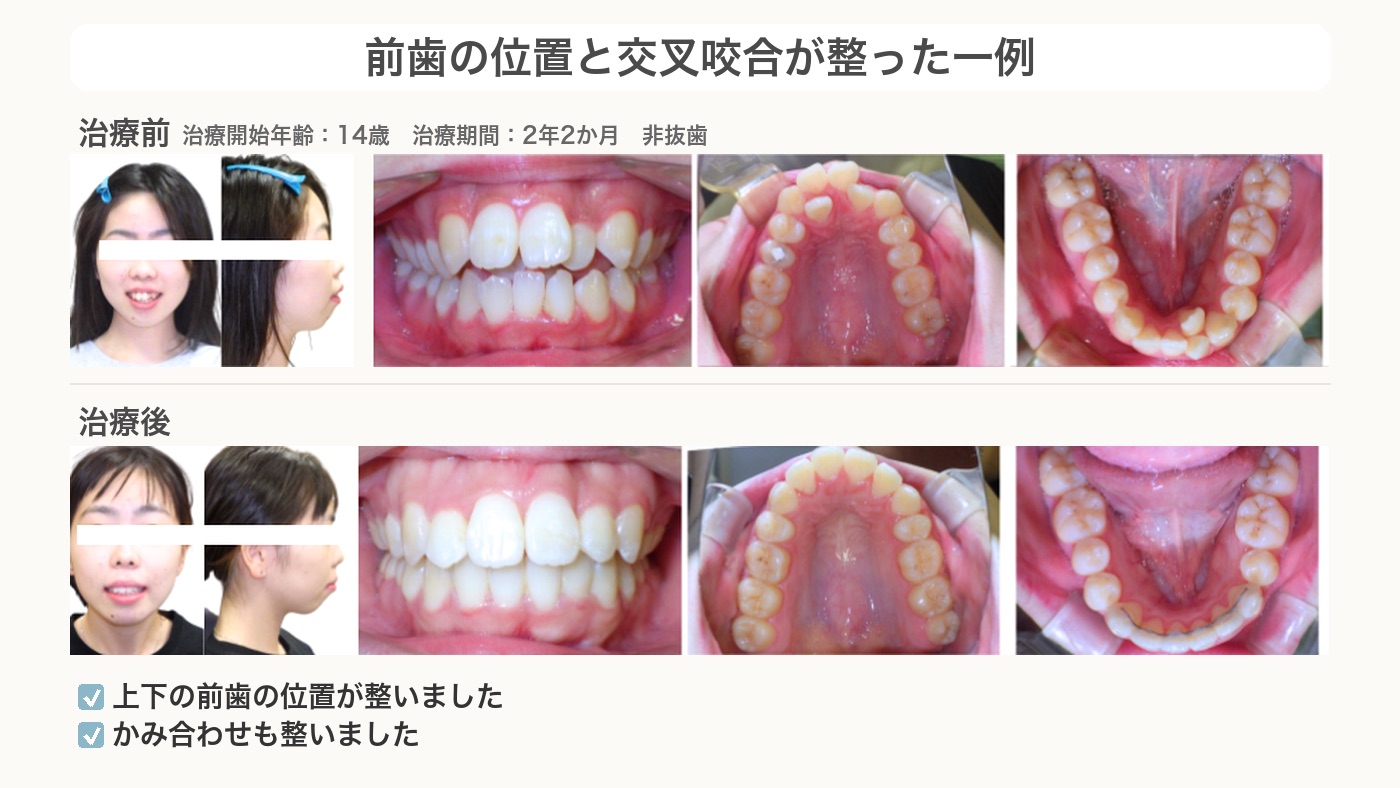 前歯の位置と交叉咬合が整った前歯で噛めない症例