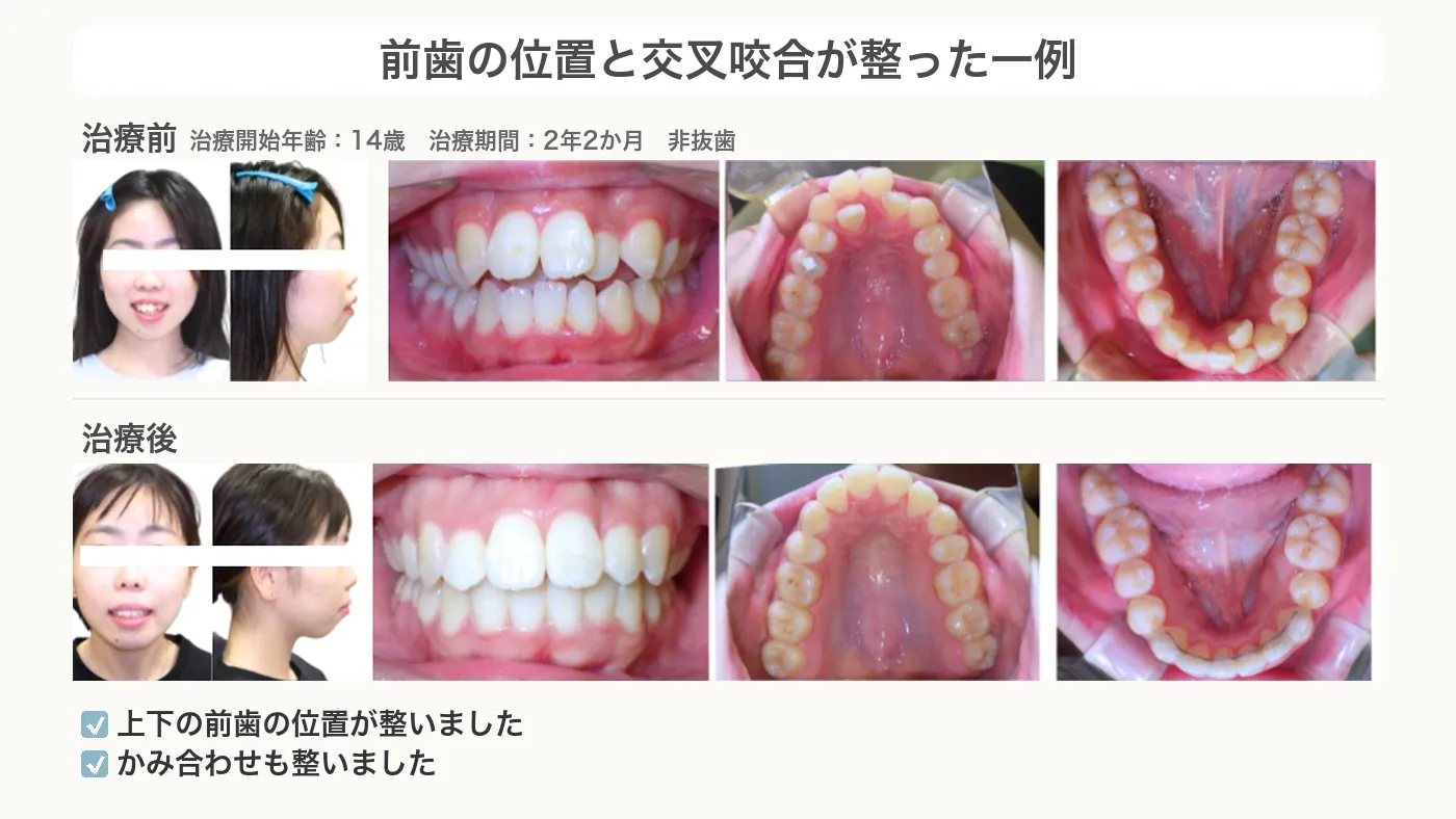 前歯の位置と交叉咬合が整った前歯で噛めない症例