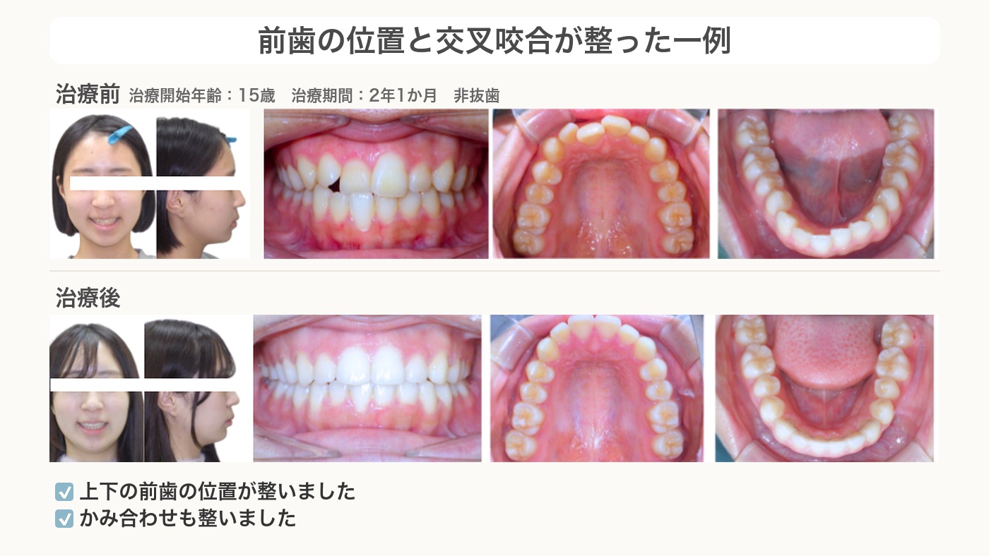前歯の位置と交叉咬合が整った交叉咬合の症例