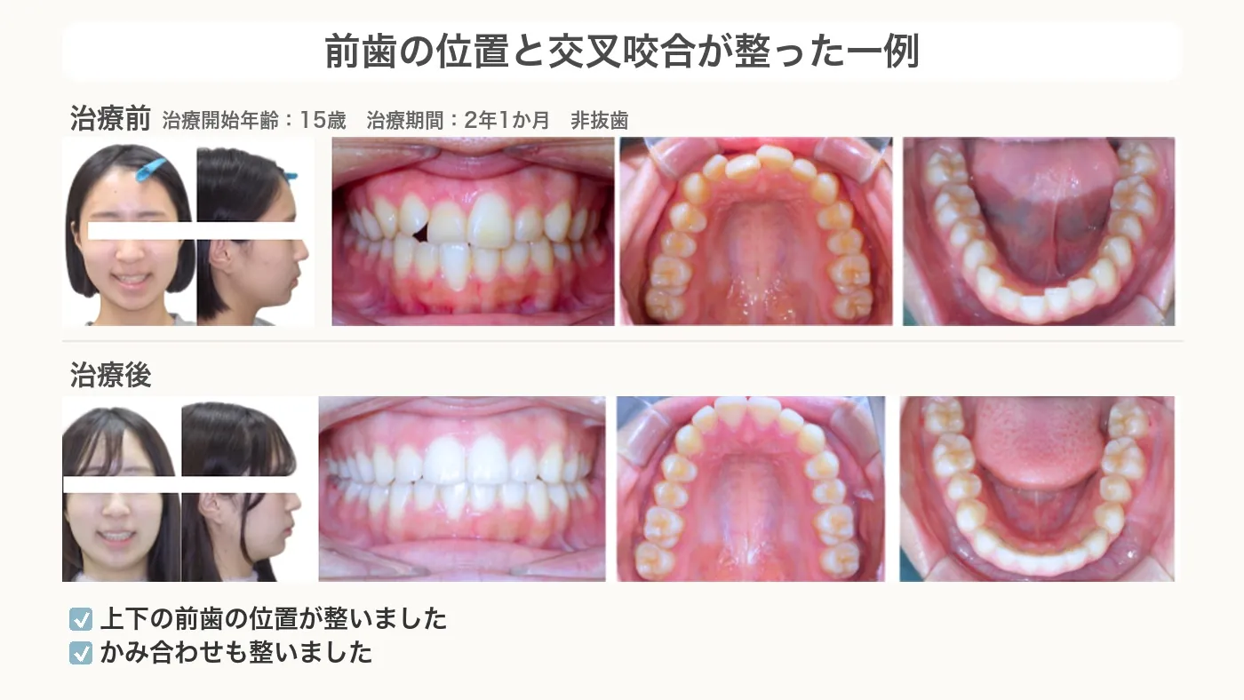 前歯の位置と交叉咬合が整った交叉咬合の症例