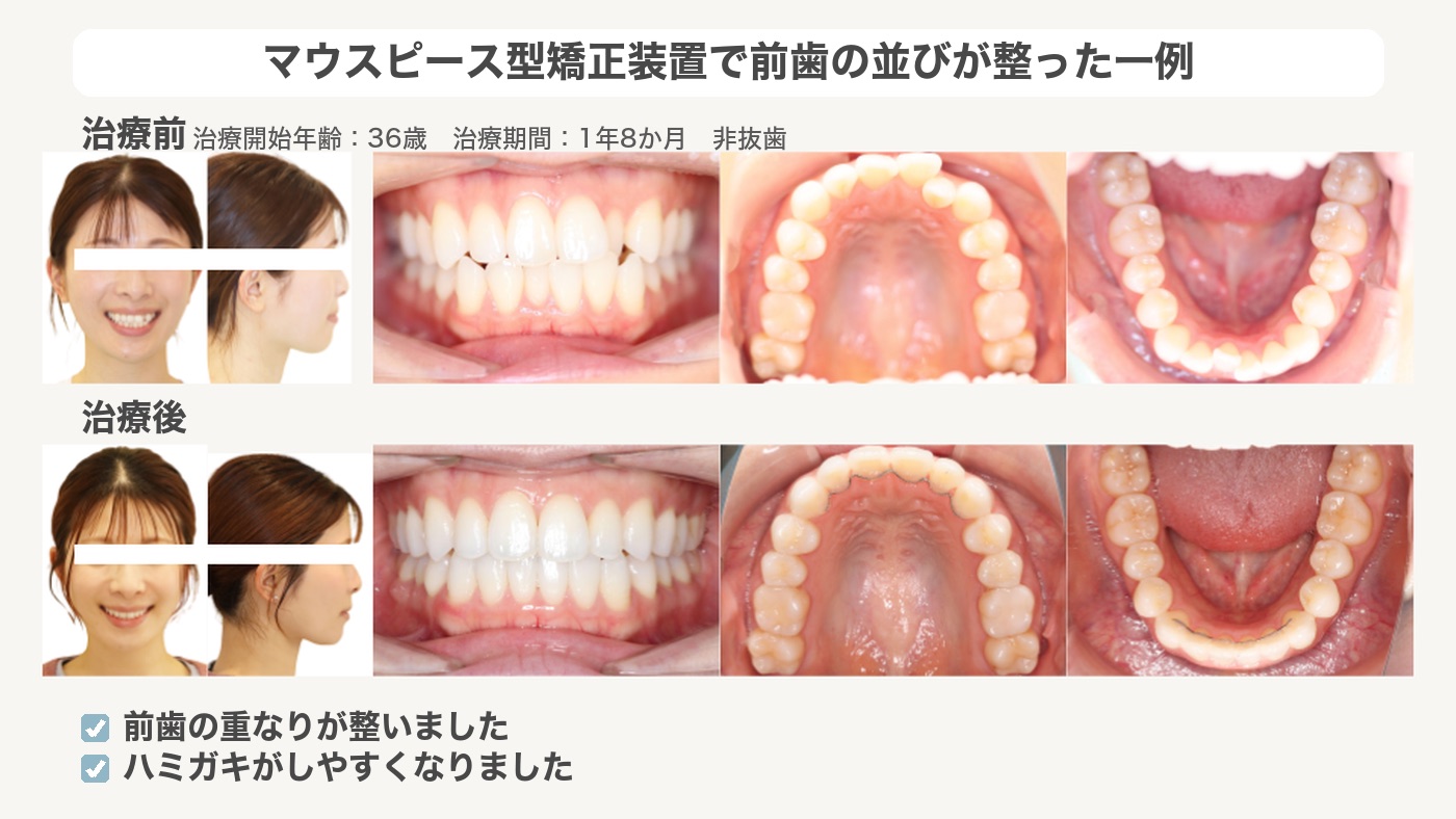 マウスピース型矯正装置で前歯の並びが整った症例