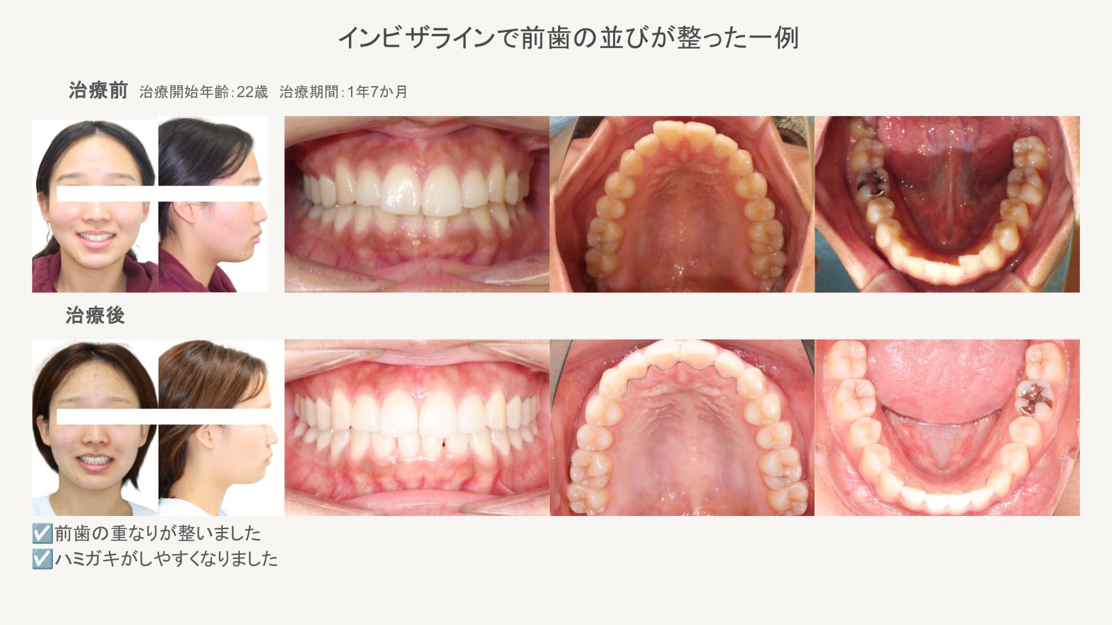 マウスピース型矯正装置で前歯の重なりが整った症例