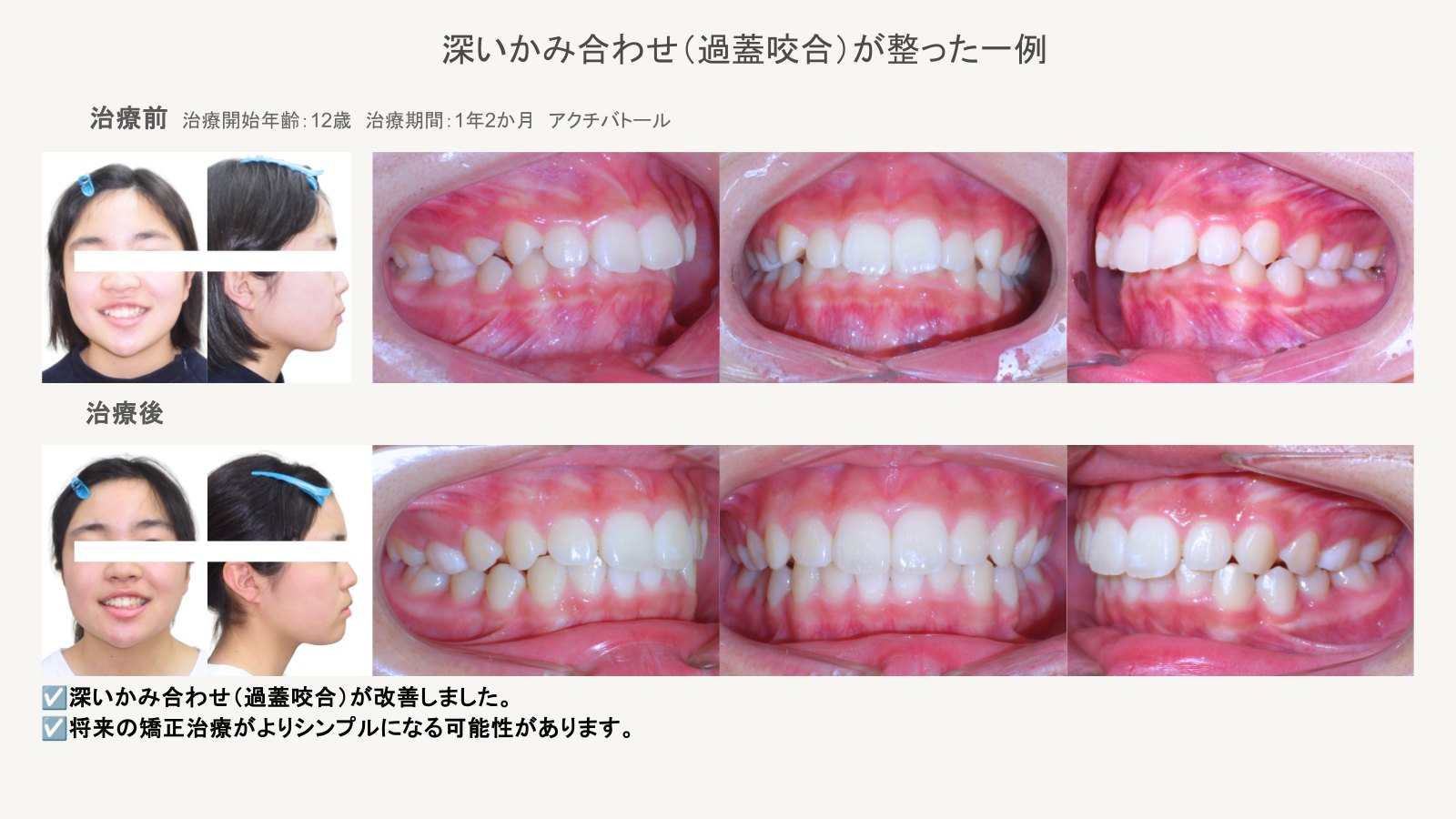 アクチバトール治療で深いかみ合わせが整った症例