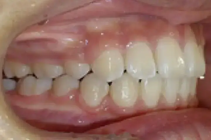 大人の歯並び治療症例