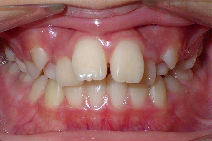 こどもの歯並び治療症例