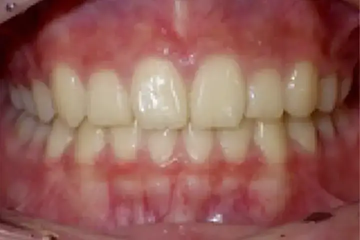 こどもの歯並び治療症例