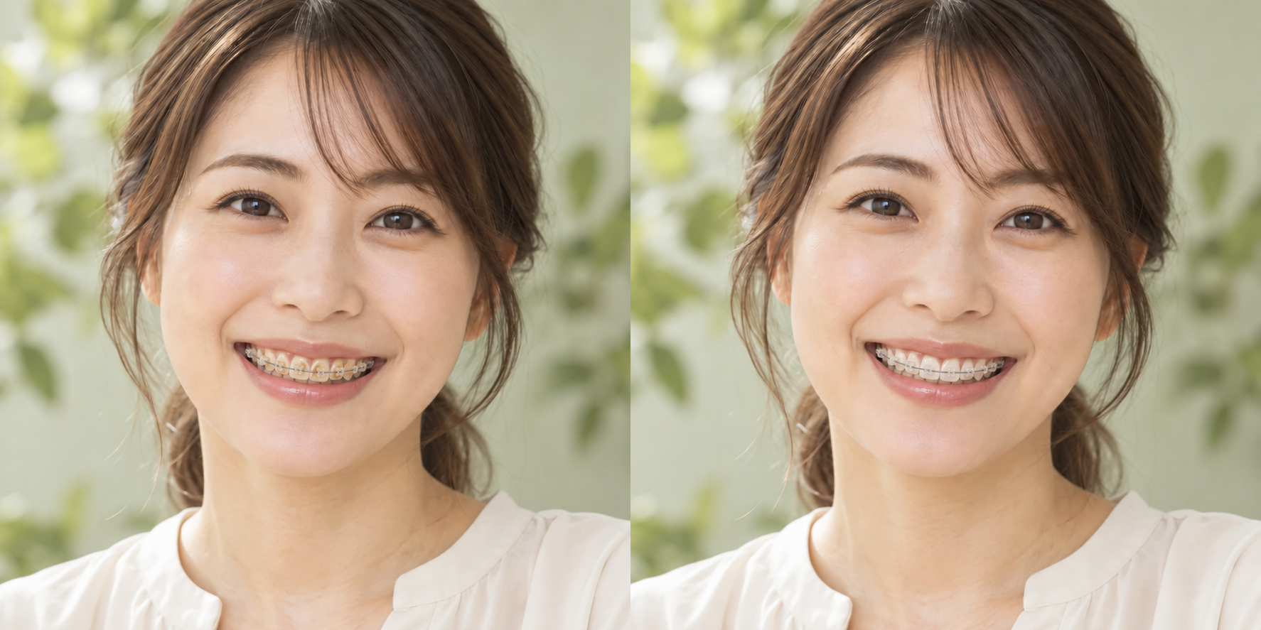 セラミックブラケットを装着した同じ女性モデルで、歯の表面の着色がある状態と除去した状態を示す説明用比較画像。実際の症例ではありません。