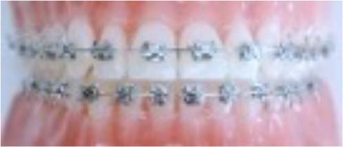 ワイヤー矯正メタルブラケット