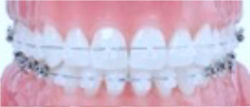 ワイヤー矯正セラミックブラケット