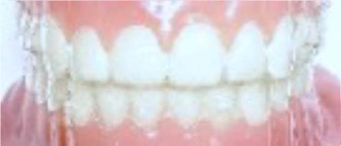 インビザライン