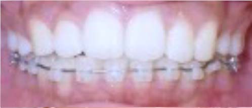 ハーフリンガル