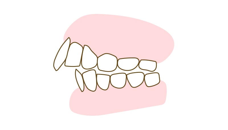 上顎前突 (出っ歯)