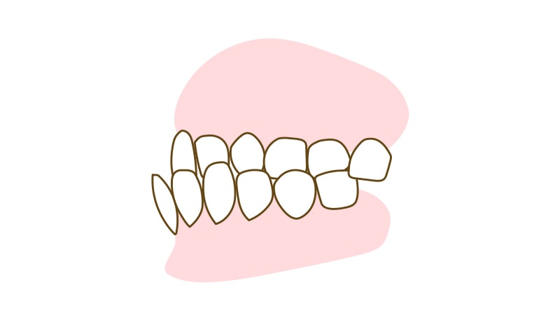 反対咬合(受け口)