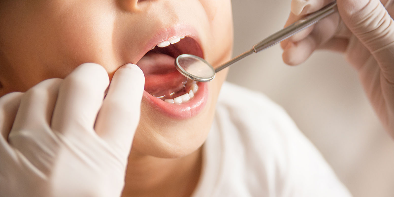 小児矯正のメリット・デメリット