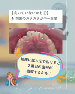 前歯のガタガタが中程度〜重度の歯並び(上あご)のイラスト