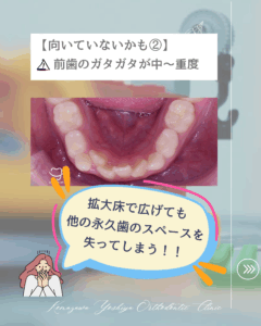 前歯のガタガタが中程度〜重度の歯並び(下あご)のイラスト