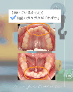 前歯のガタガタが「わずか」な歯並びのイラスト
