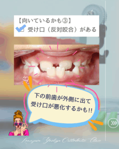 受け口(反対咬合)の歯並びのイラスト