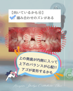 交叉咬合(上下のかみ合わせのズレ)のイラスト